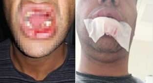 Büyükbaş hayvanın tekmesi çenesini kırdı