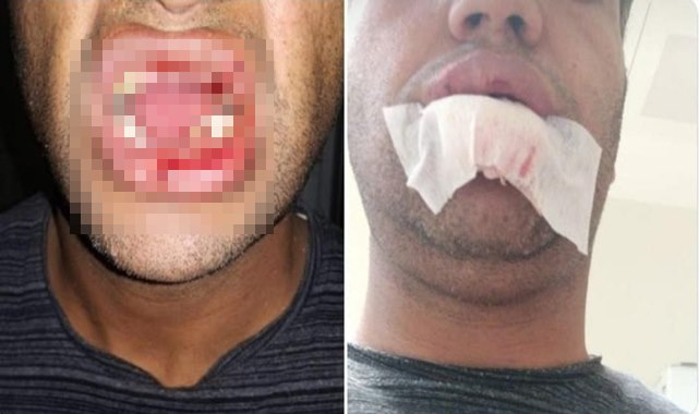Büyükbaş hayvanın tekmesi çenesini kırdı