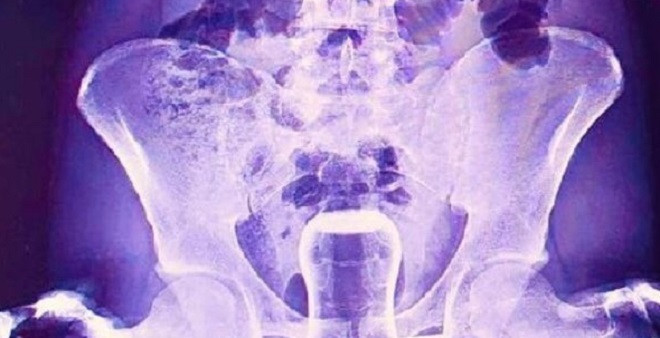 Şanlıurfa'da inanılmaz olay: Hacamat yaptırayım derken...