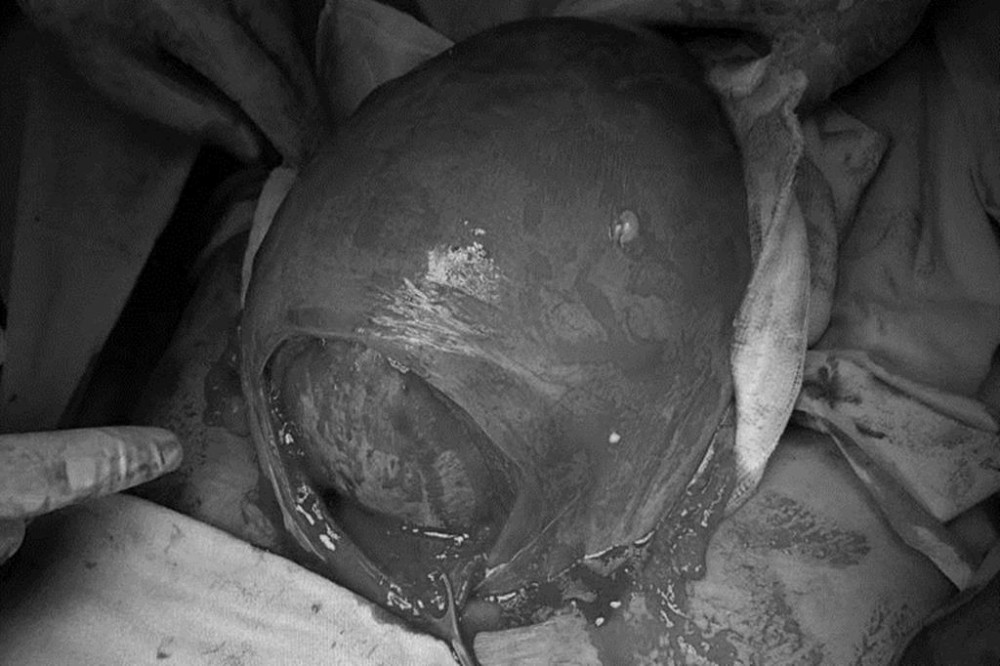 Doğum yapan kadının karnından çıktı! Tam 23 santim