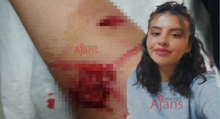 Harran Üniversitesinde köpek saldırısı! Genç kız yaralandı