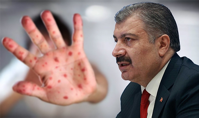 Bakan Koca'dan açıklama: Türkiye’de maymun çiçeği vakası görüldü mü?