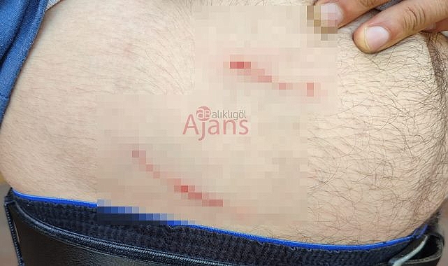 Şanlıurfa'da sokak köpeğinin saldırısına uğrayan vatandaş yaralandı