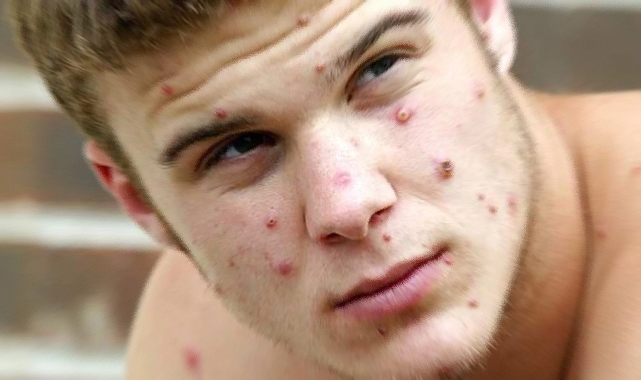 Maymun çiçeği virüsü için küresel acil durum ilanı