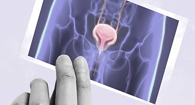 Mesane Kanseri: Görmezden gelmeyi göze alamayacağınız 5 uyarı işareti