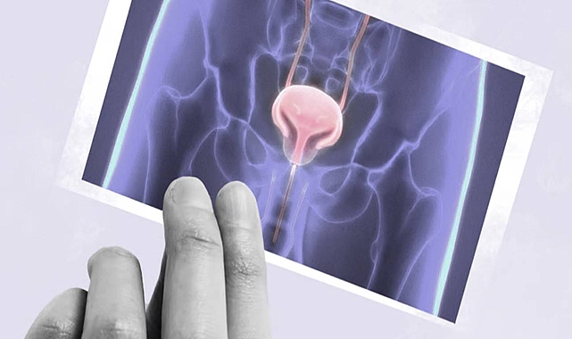 Mesane Kanseri: Görmezden gelmeyi göze alamayacağınız 5 uyarı işareti