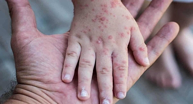 Kızamık vakalarının en yaygın olduğu 5 il açıklandı!