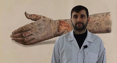 Cüzzam hastalığı nedir, tedavisi nasıl olur?