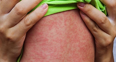 Kızamık salgınları hakkında bilmeniz gerekenler