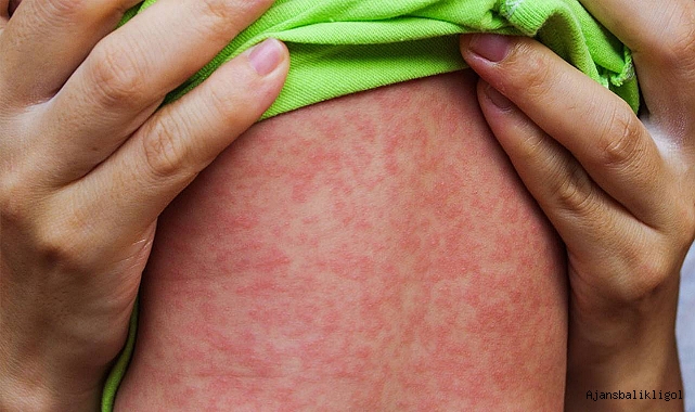 Kızamık salgınları hakkında bilmeniz gerekenler