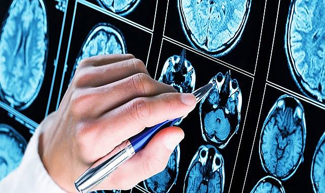 Çalışma: İşte demans için en büyük üç risk faktörü