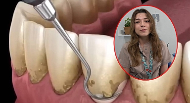 Uzmanı açıkladı! Diş taşı nedir, nasıl tedavi edilir?