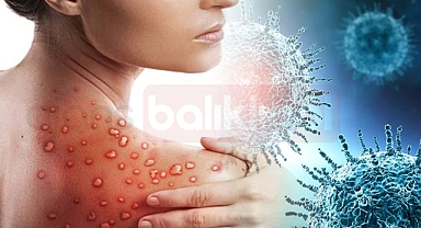 Sağlık Bakanlığı Açıkladı! Maymun Çiçeği Virisünde Merak Edilen Sorular