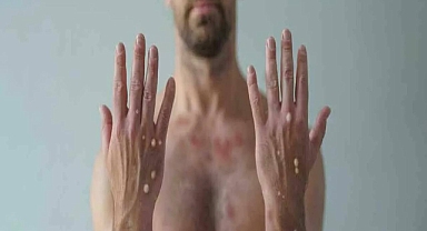 Sağlık Bakanlığı Açıkladı! Maymun Çiçeği Virüsü Türkiye'de Var mı?