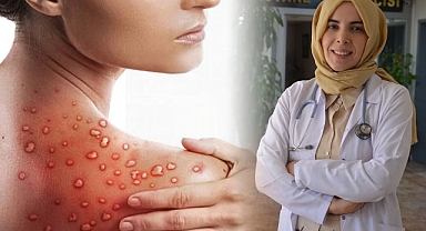 Urfa’da Görevli Uzman Uyardı! Maymun Çiçeği’nden Korunmanın Yolları 