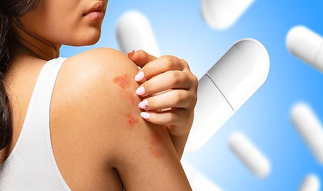 Egzama İçin Probiyotikler: Semptomların İyileşmesine Yardımcı Olabilir mi?