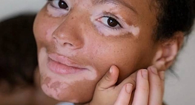 Vitiligo Hastaları İçin Psikososyal Desteğe Dikkat Çekiliyor