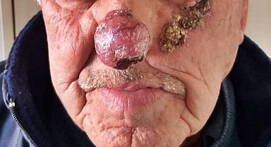 Dünyada Cilt Kanseri Vakaları! Hangi Ülke İlk Sırada?