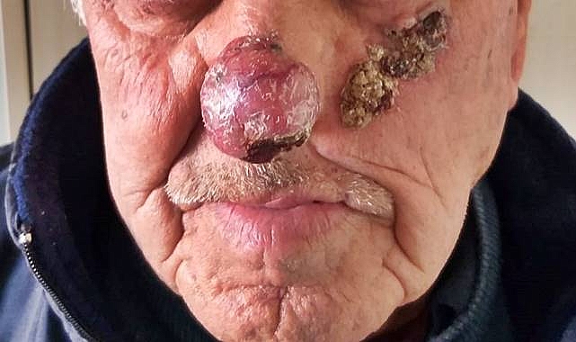 Dünyada Cilt Kanseri Vakaları! Hangi Ülke İlk Sırada?