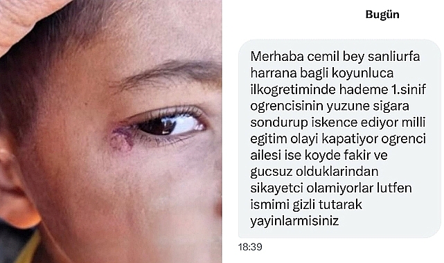 Harran’da Öğrencinin Yüzünde Sigara Söndürdü: Temizlik Görevlisi Tutuklandı