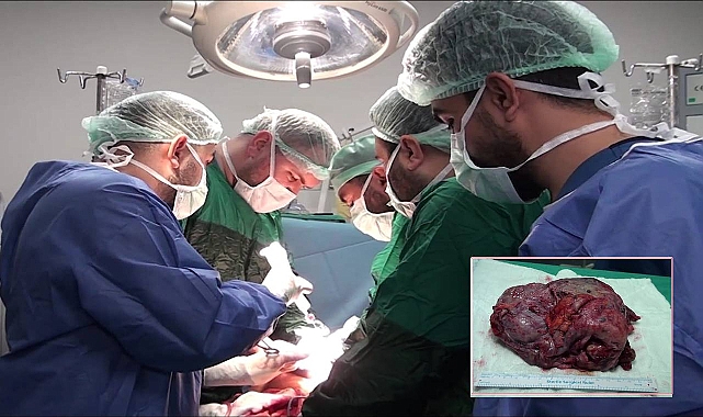 Şanlıurfa’da 25 Santimetrelik Dev Kist Başarıyla Alındı!