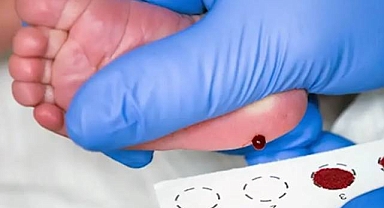 Uzmanından Uyarı: Topuk Kanı Taraması Hayat Kurtarıyor