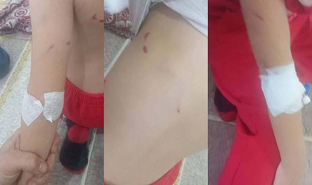 Viranşehir’de Sokak Köpekleri 6 Yaşındaki Kız Çocuğuna Saldırdı