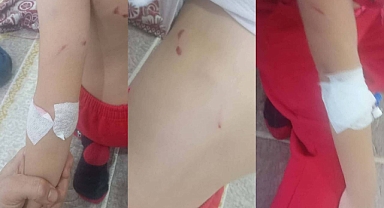 Viranşehir’de Sokak Köpekleri 6 Yaşındaki Kız Çocuğuna Saldırdı